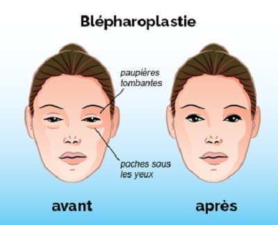 Blepharoplastie prix