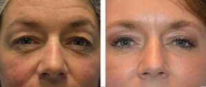 blepharoplastie laser avant apres